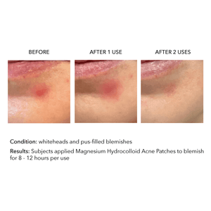 Magnesium Hydrocolloid Acne Patches